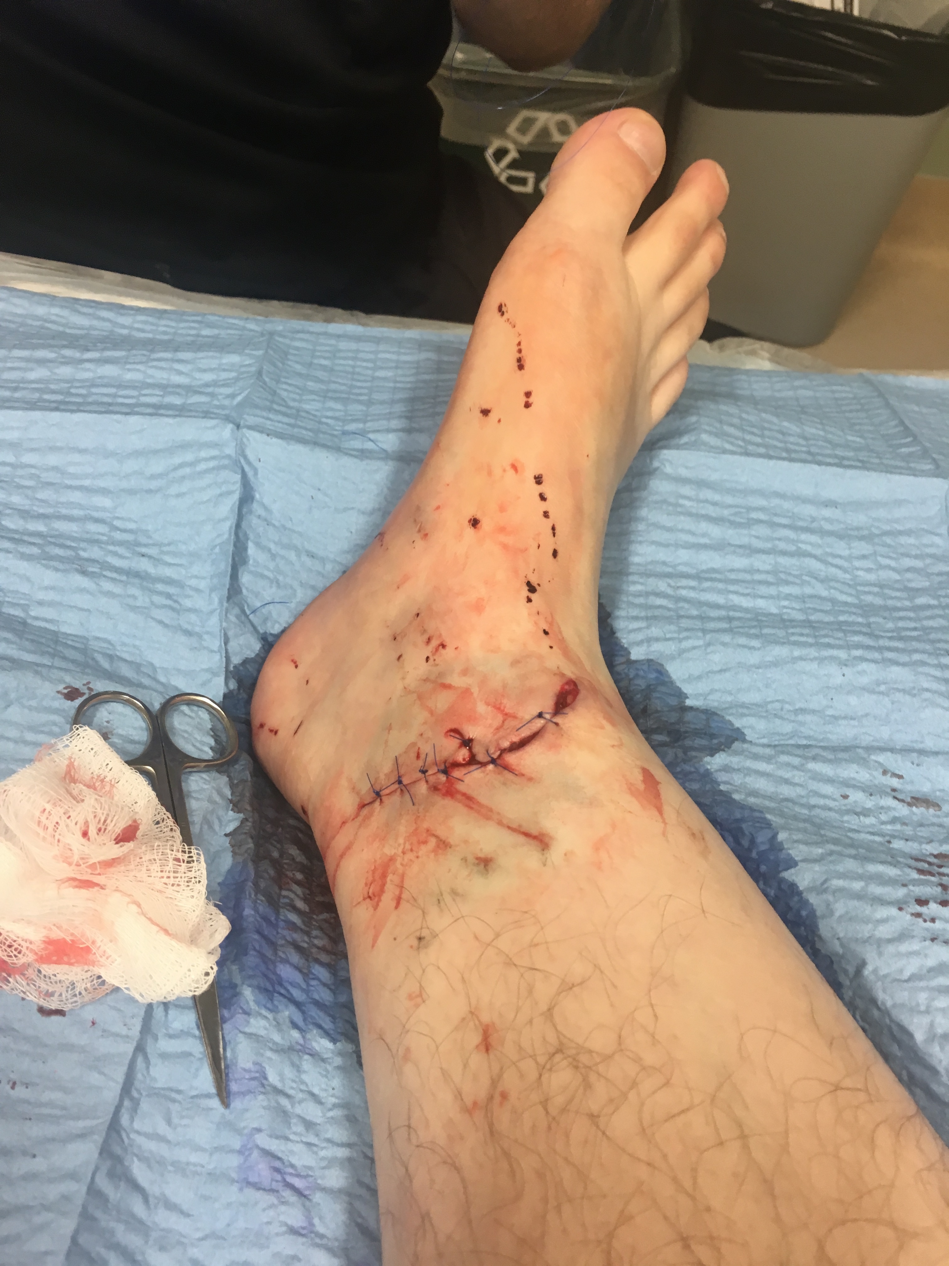 Ankle with stitches